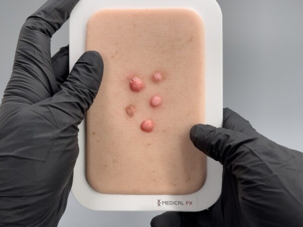Pocketwunde Dermafibrom – Bild 3