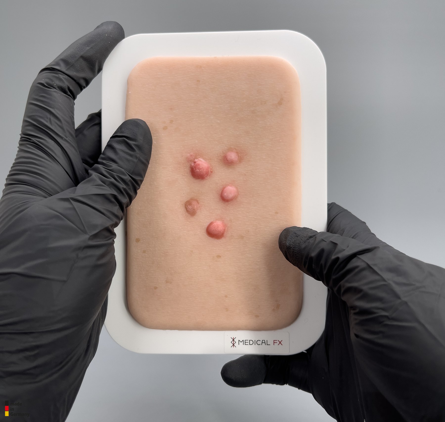 Pocketwunde Dermafibrom – Bild 3