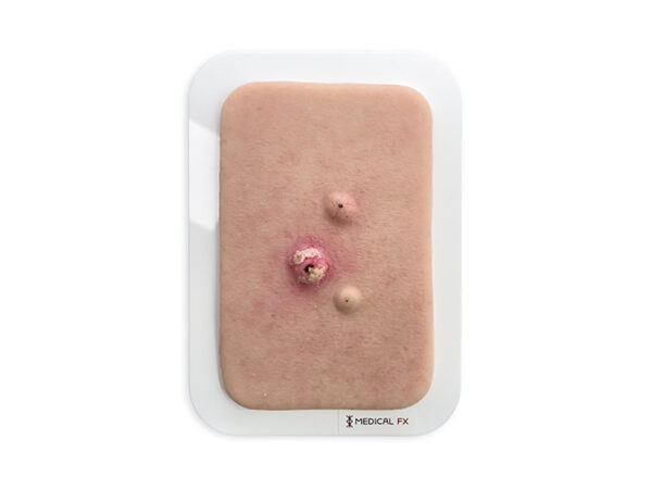 Pocketwunde Cysta epidermalis (Epidermalzyste)