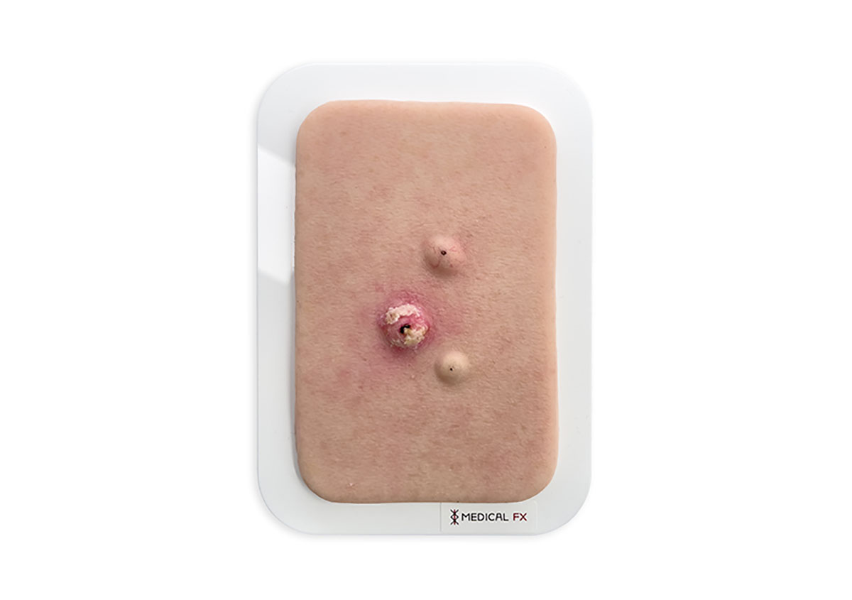 Pocketwunde Cysta epidermalis (Epidermalzyste)