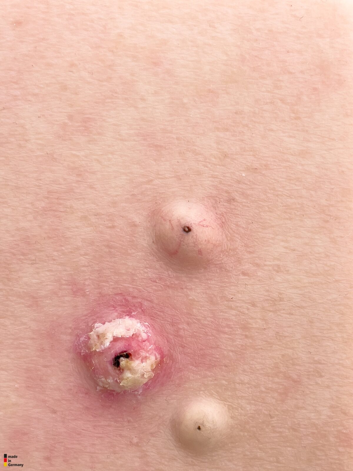 Pocketwunde Cysta epidermalis (Epidermalzyste)