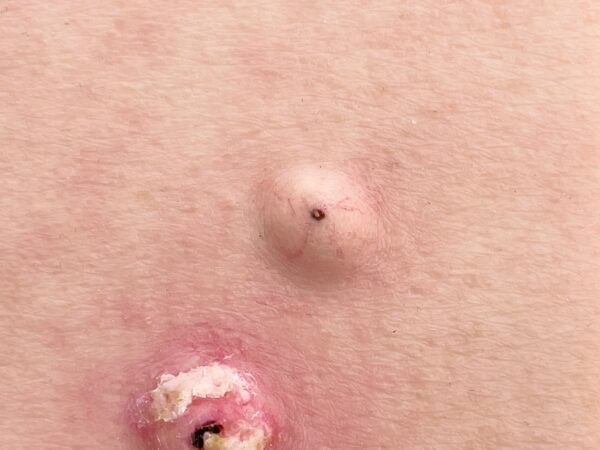 Pocketwunde Cysta epidermalis (Epidermalzyste) – Bild 2