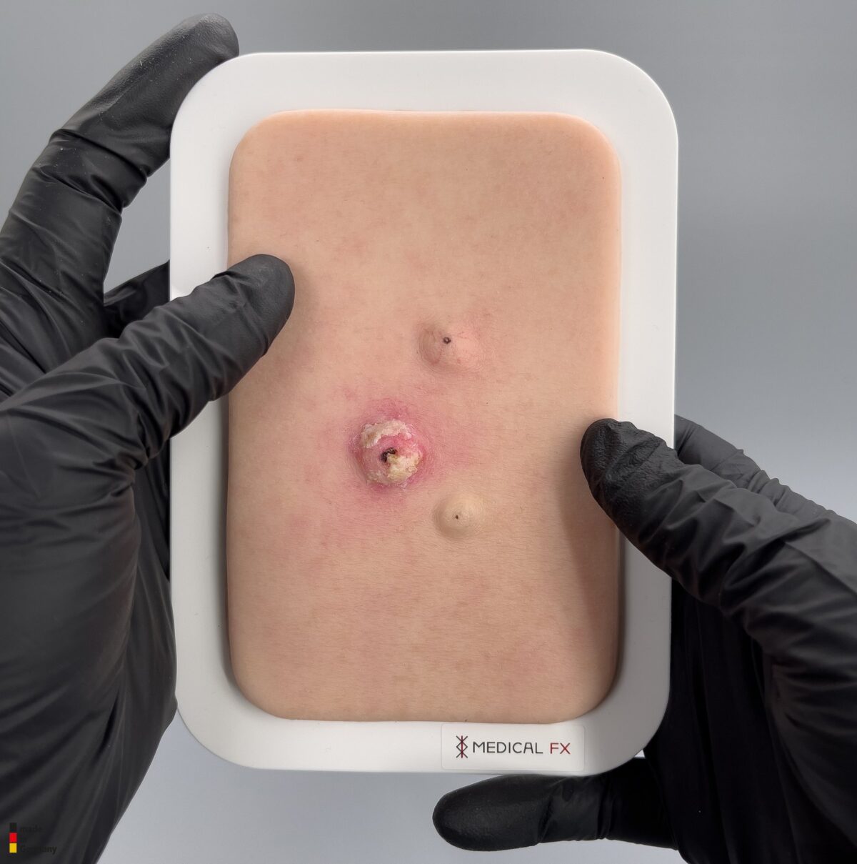Pocketwunde Cysta epidermalis (Epidermalzyste)