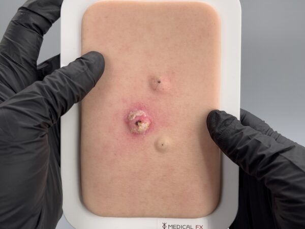 Pocketwunde Cysta epidermalis (Epidermalzyste) – Bild 3