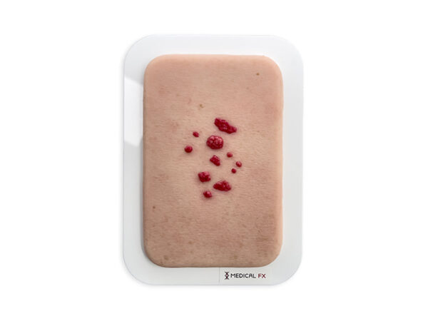 Pocketwunde Seniles Hämangiom