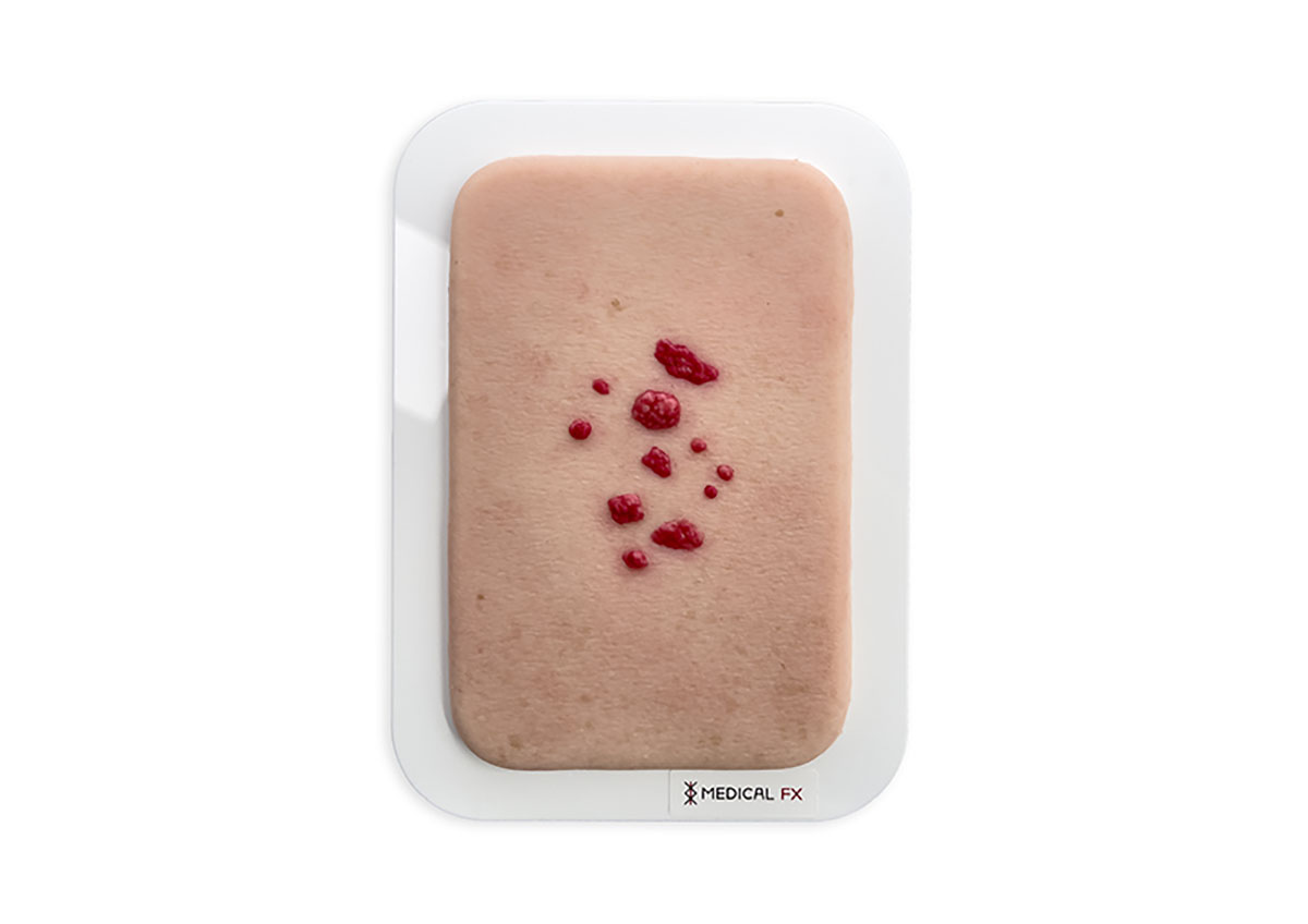 Pocketwunde Seniles Hämangiom