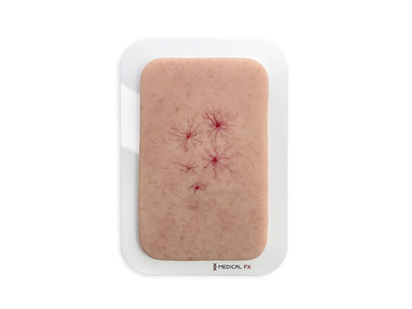 Pocketwunde Naevus araneus (Spinnennävus)