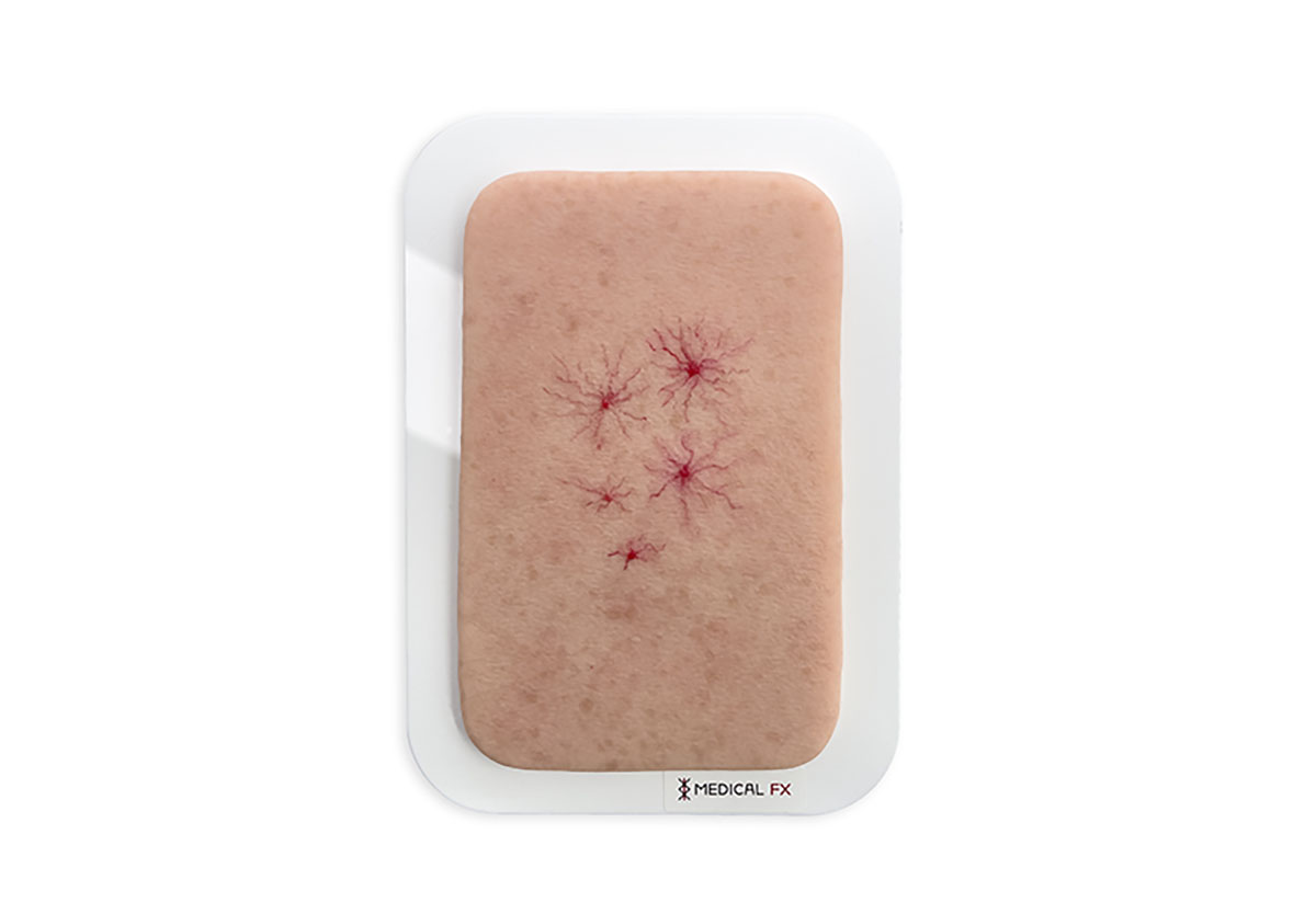 Pocketwunde Naevus araneus (Spinnennävus)