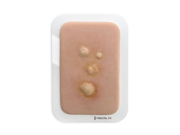 Pocketwunde Clavus (Druckschwiele)