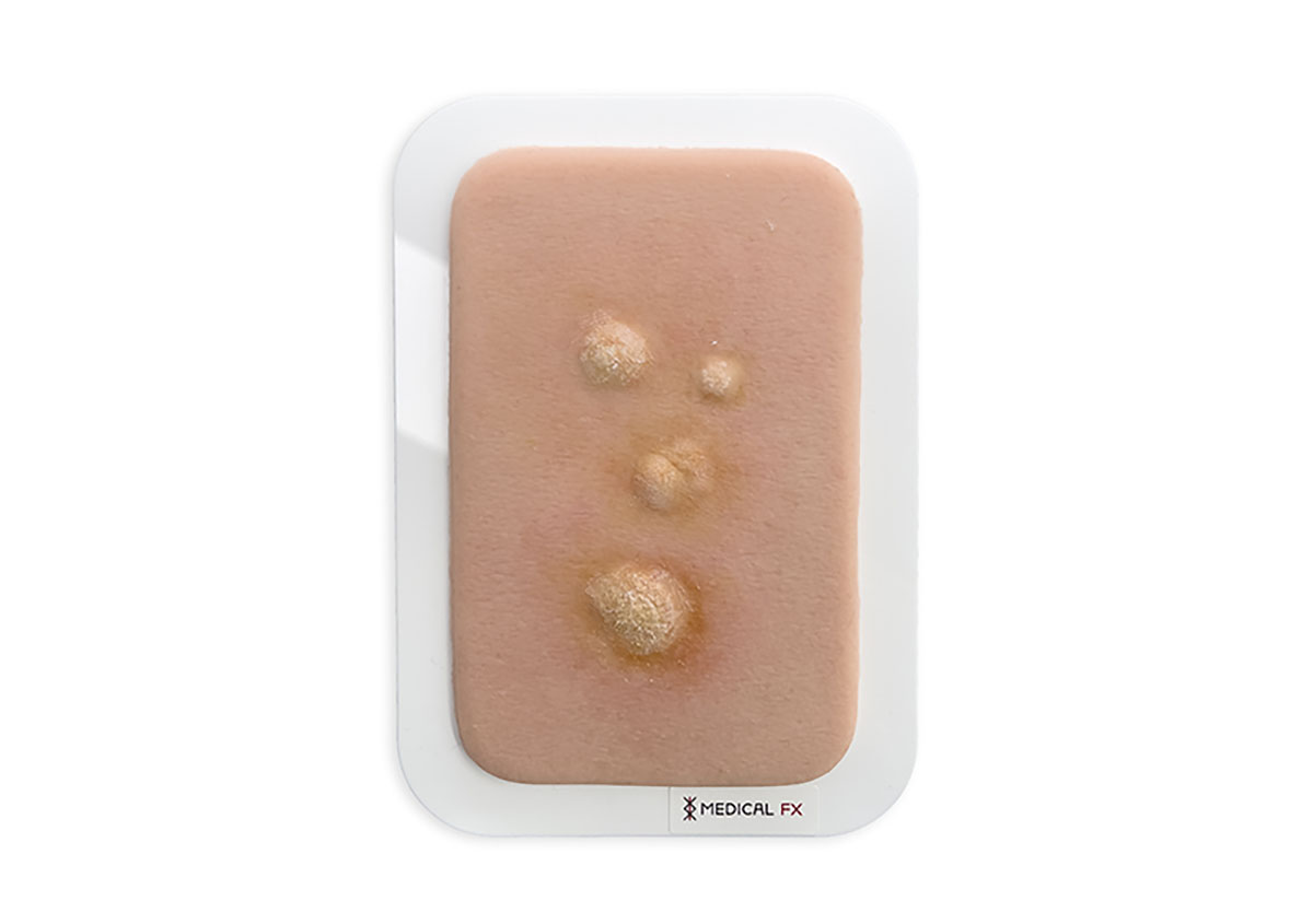 Pocketwunde Clavus (Druckschwiele)