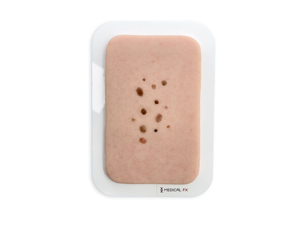 Pocketwunde Melanozytärer Nävus (Muttermal)