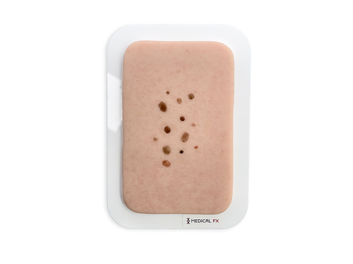 Pocketwunde Melanozytärer Nävus (Muttermal)