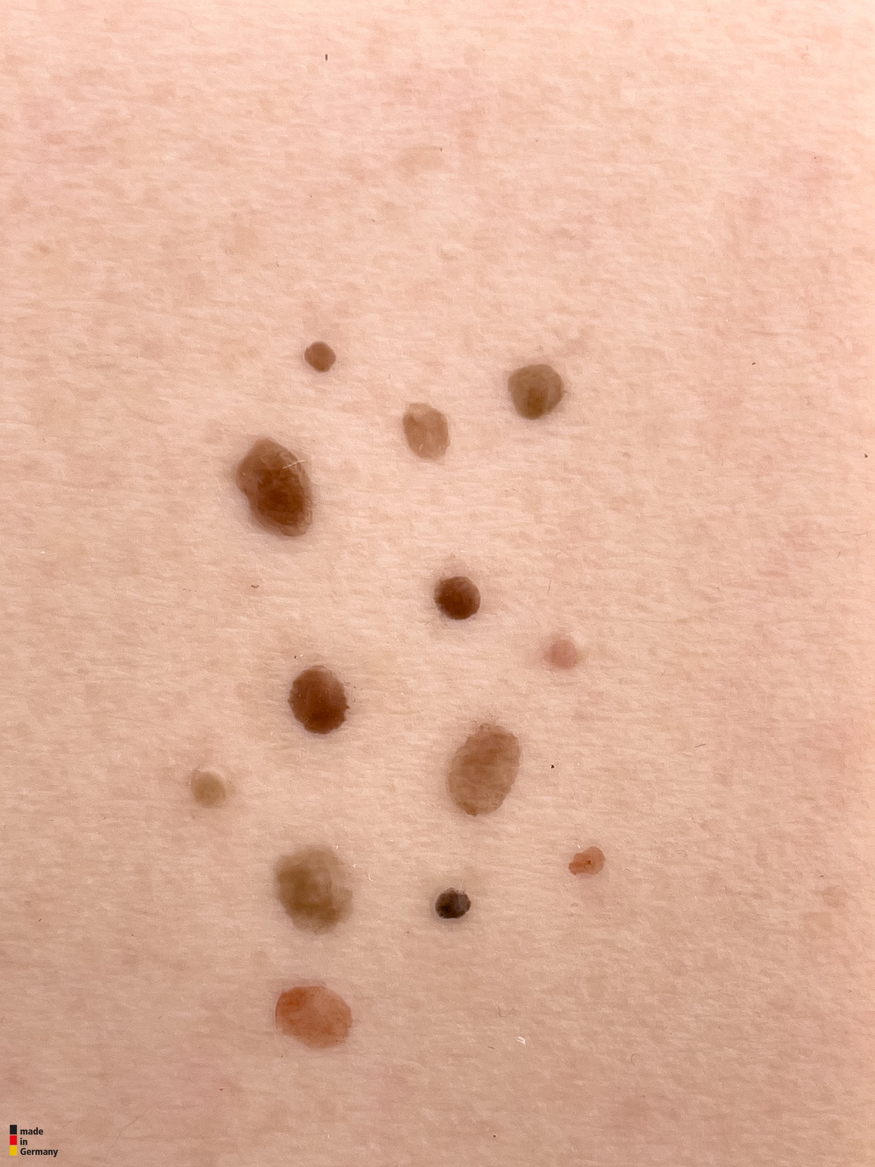 Pocketwunde Melanozytärer Nävus (Muttermal) – Bild 2