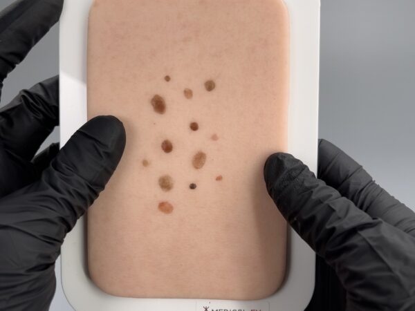 Pocketwunde Melanozytärer Nävus (Muttermal) – Bild 3