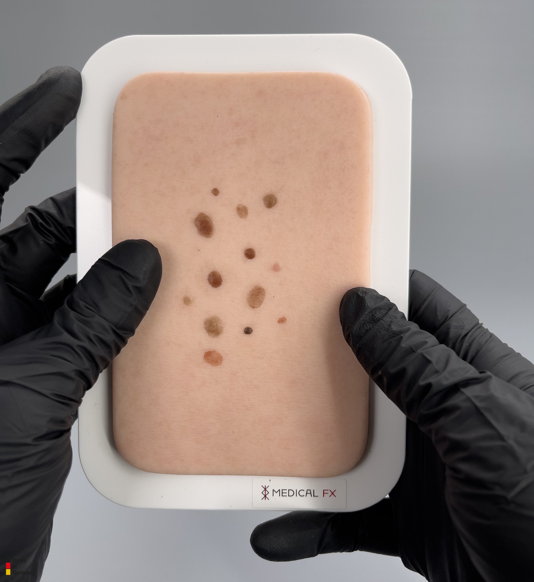 Pocketwunde Melanozytärer Nävus (Muttermal) – Bild 3