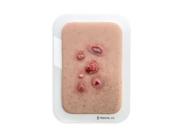 Spinozellulaeres Karzinom Plattenepithelkarzinom