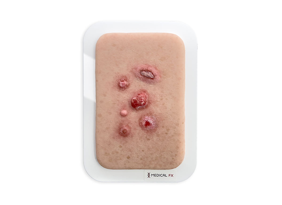 Spinozellulaeres Karzinom Plattenepithelkarzinom