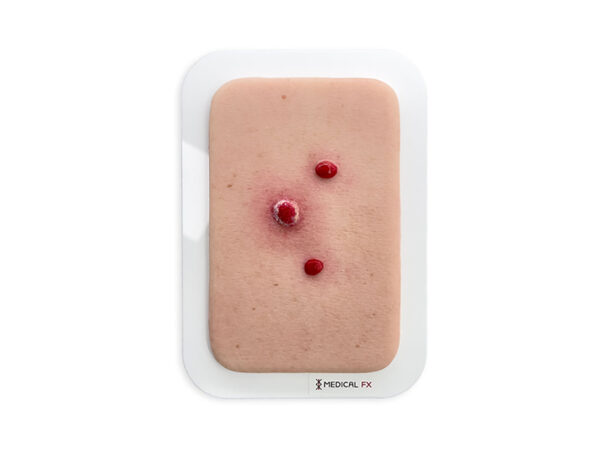 Pocketwunde Granuloma pyogenicum