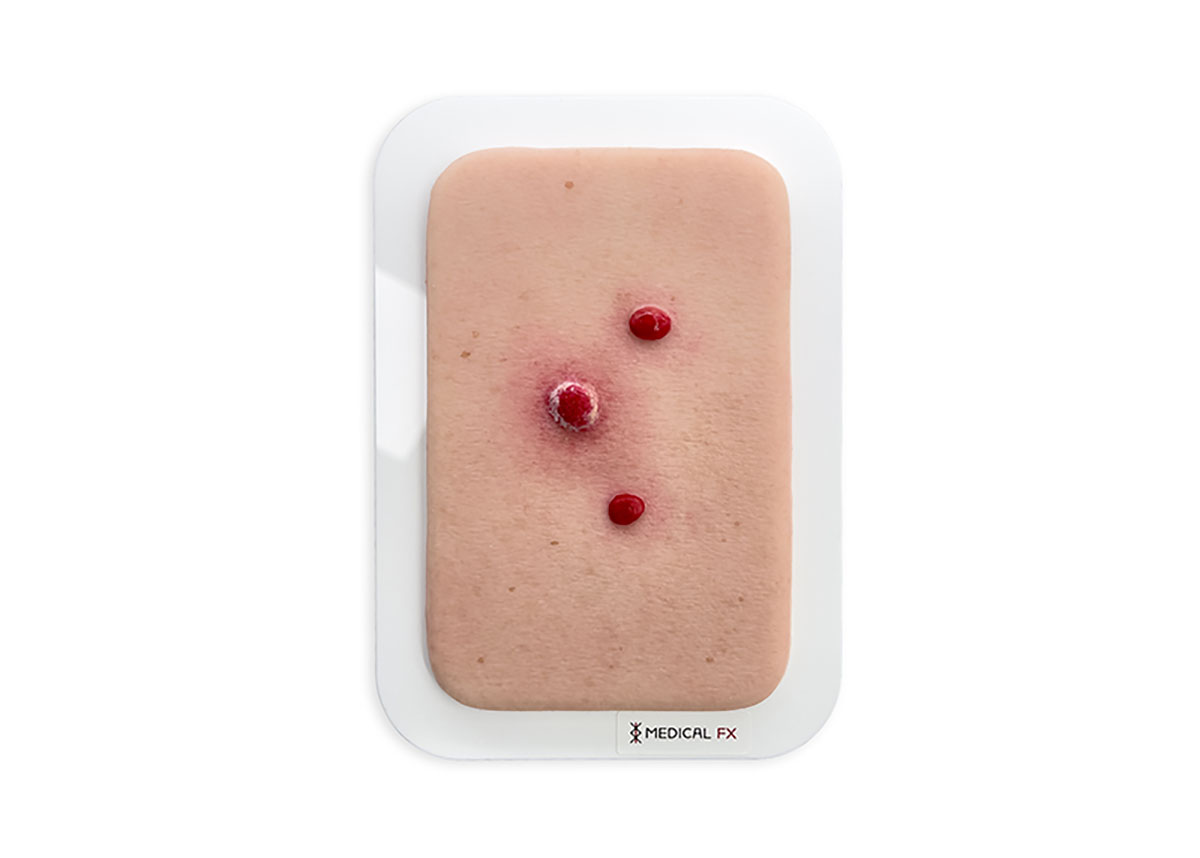 Pocketwunde Granuloma pyogenicum