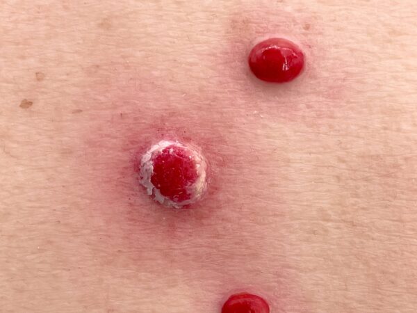 Pocketwunde Granuloma pyogenicum – Bild 2