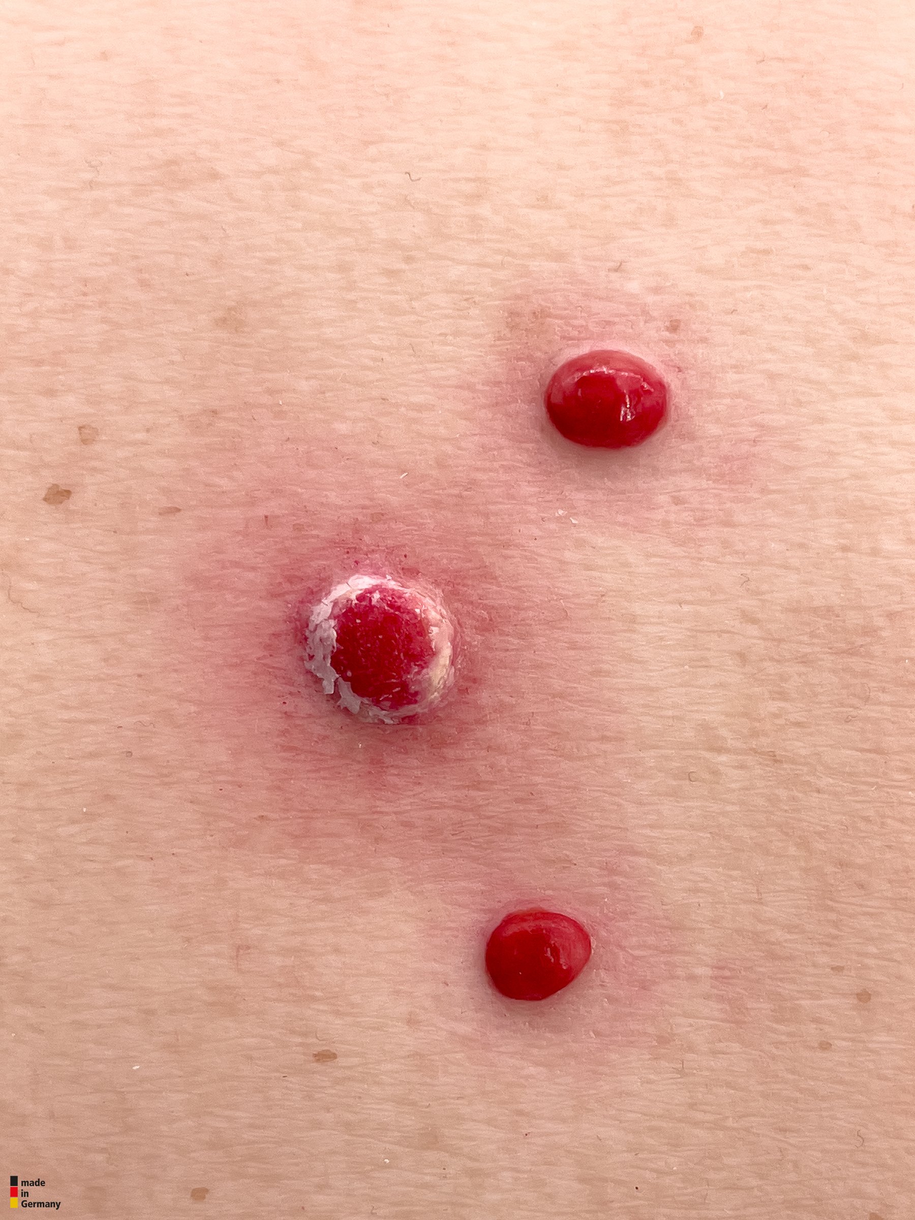 Pocketwunde Granuloma pyogenicum – Bild 2