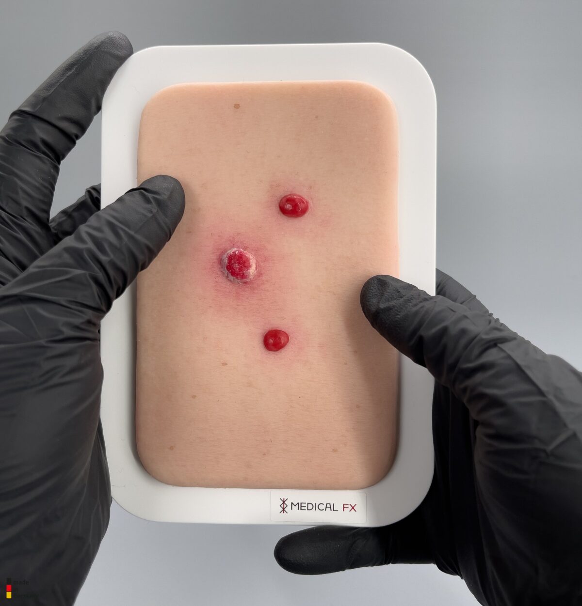 Pocketwunde Granuloma pyogenicum