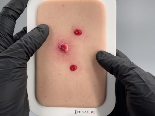 Pocketwunde Granuloma pyogenicum – Bild 3