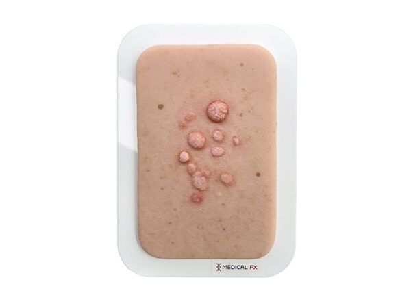 realistische Abbildung einer Verruca vulgaris auf rechteckigem Stück Haut