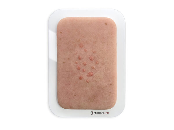 Realistische Darstellung einer Talgdruesenhyperplasie