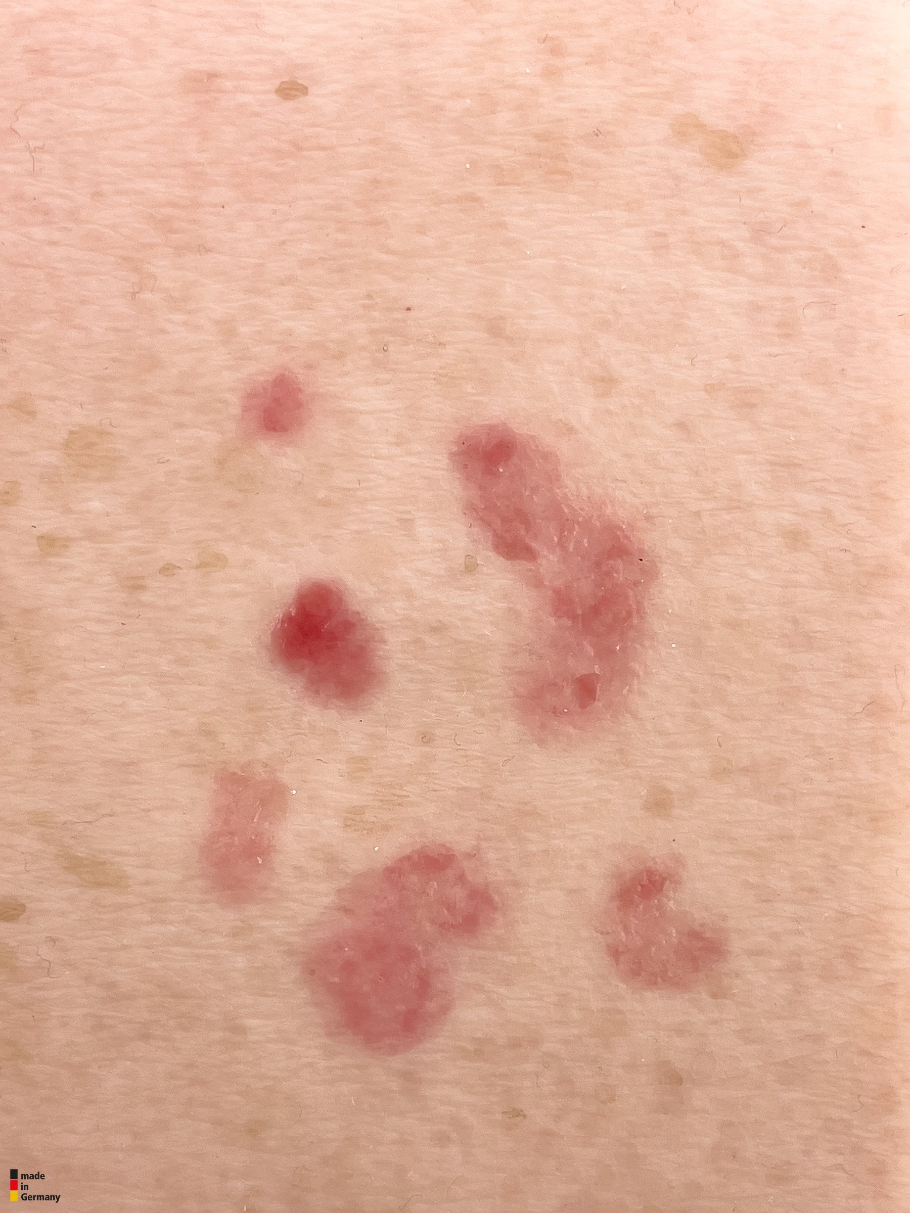 Pocketwunde Superfizielles Basaliom – Bild 2
