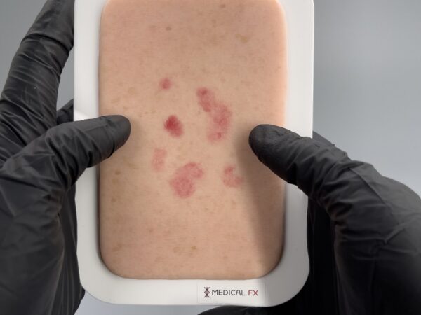Pocketwunde Superfizielles Basaliom – Bild 3