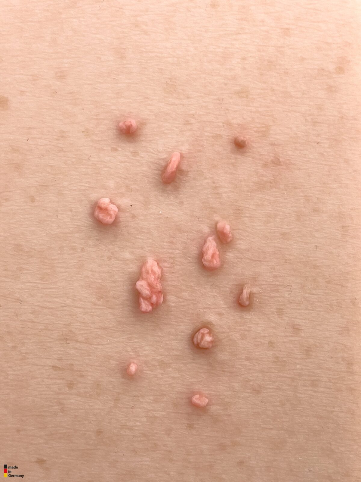 Pocketwunde Fibroma pendulans (Weiches Fibrom)