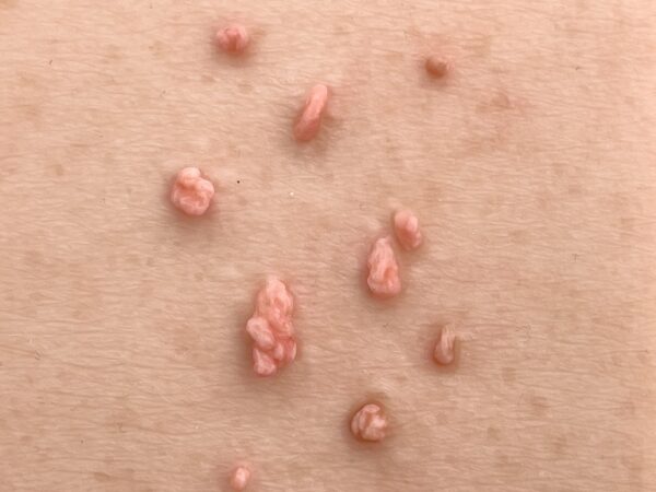 Pocketwunde Fibroma pendulans (Weiches Fibrom) – Bild 2