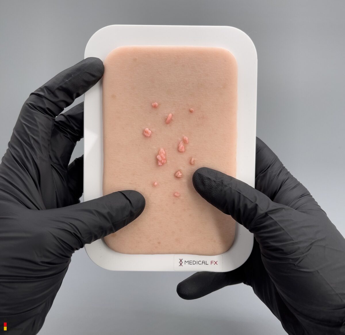 Pocketwunde Fibroma pendulans (Weiches Fibrom)