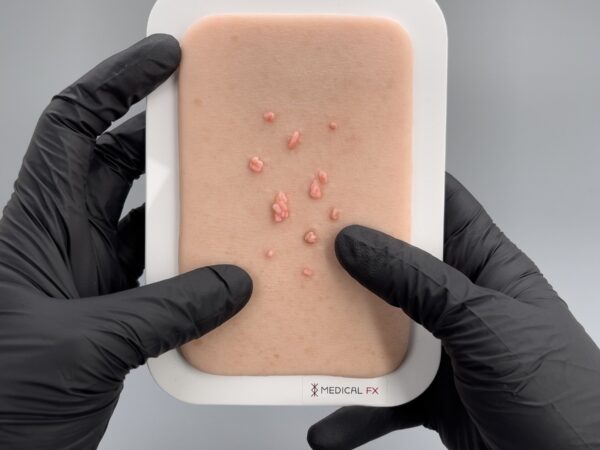 Pocketwunde Fibroma pendulans (Weiches Fibrom) – Bild 3