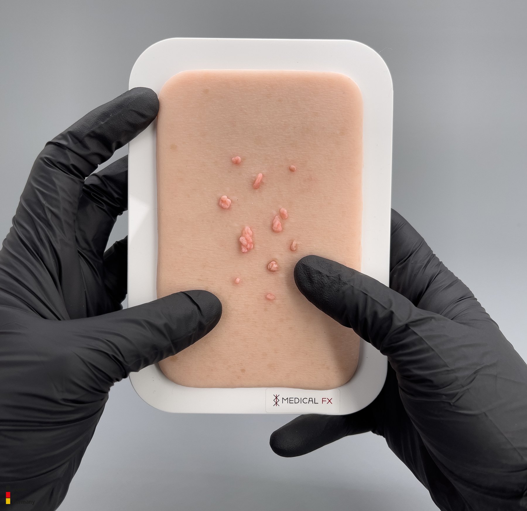 Pocketwunde Fibroma pendulans (Weiches Fibrom) – Bild 3