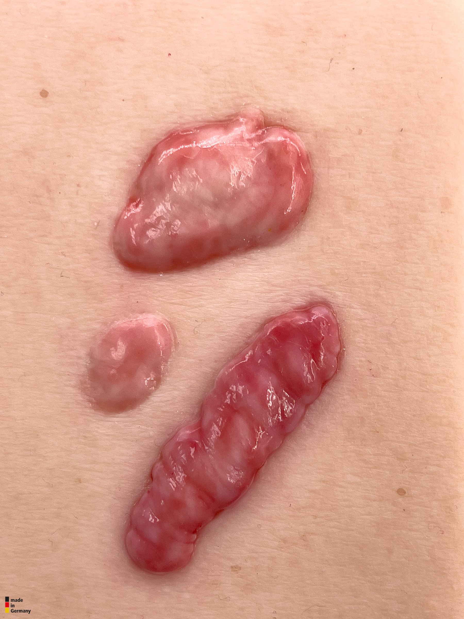 Pocketwunde Keloide Narben (Wulstnarben) – Bild 2
