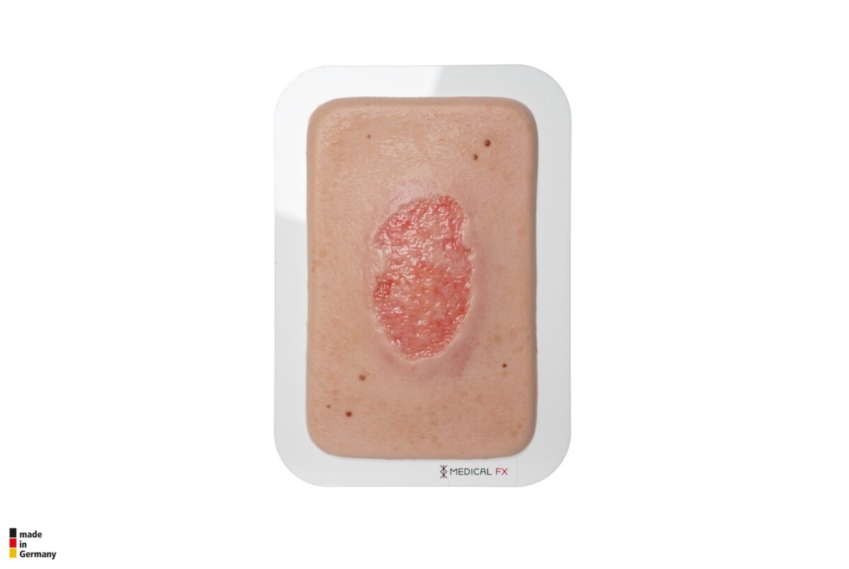 Pocketwunde Granulation mit Fibringitter