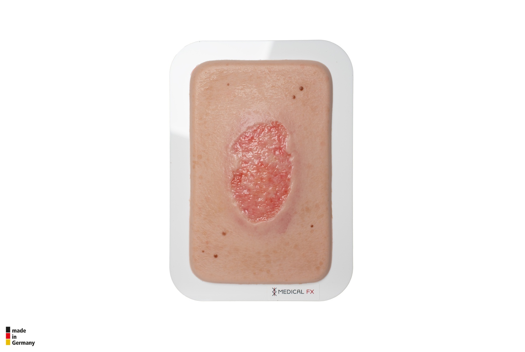 Pocketwunde Granulation mit Fibringitter – Bild 1