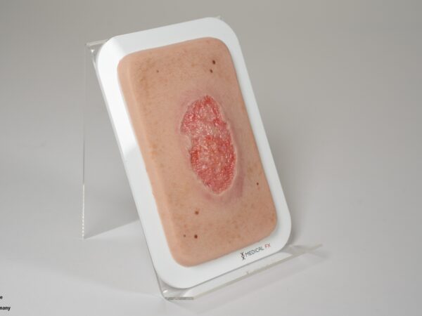 Pocketwunde Granulation mit Fibringitter – Bild 3