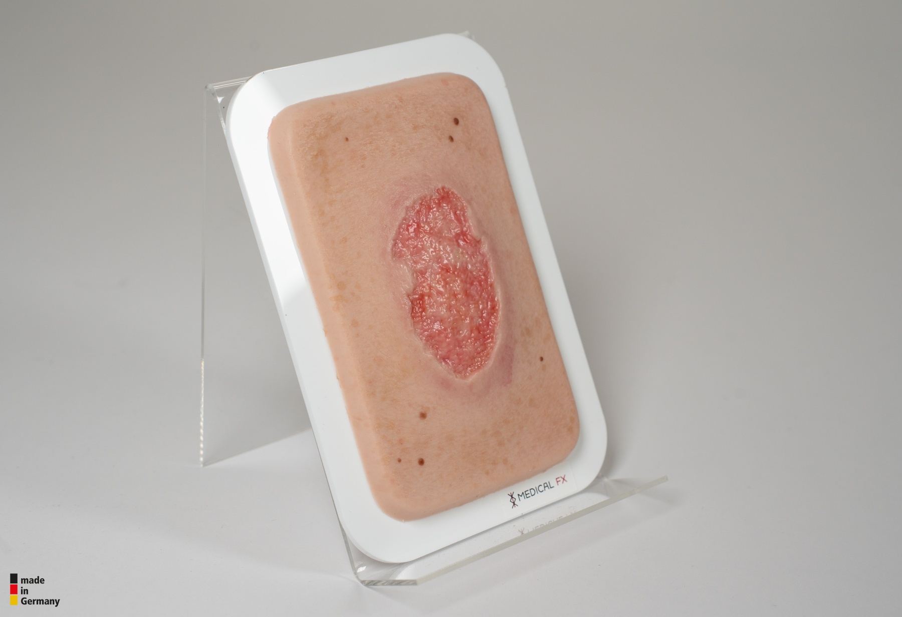 Pocketwunde Granulation mit Fibringitter – Bild 3