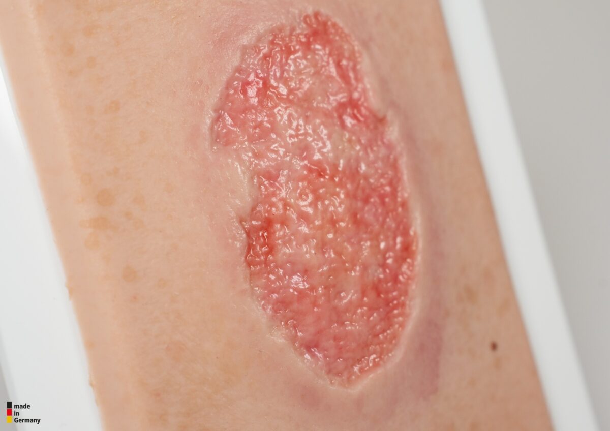 Pocketwunde Granulation mit Fibringitter