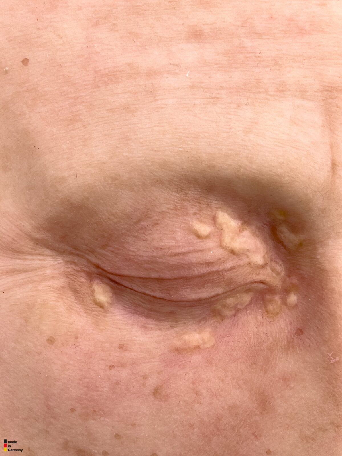 Pocketwound Xanthelasma (Lidknötchen)