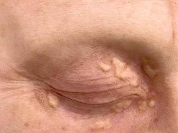 Pocketwound Xanthelasma (Lidknötchen) – Bild 2