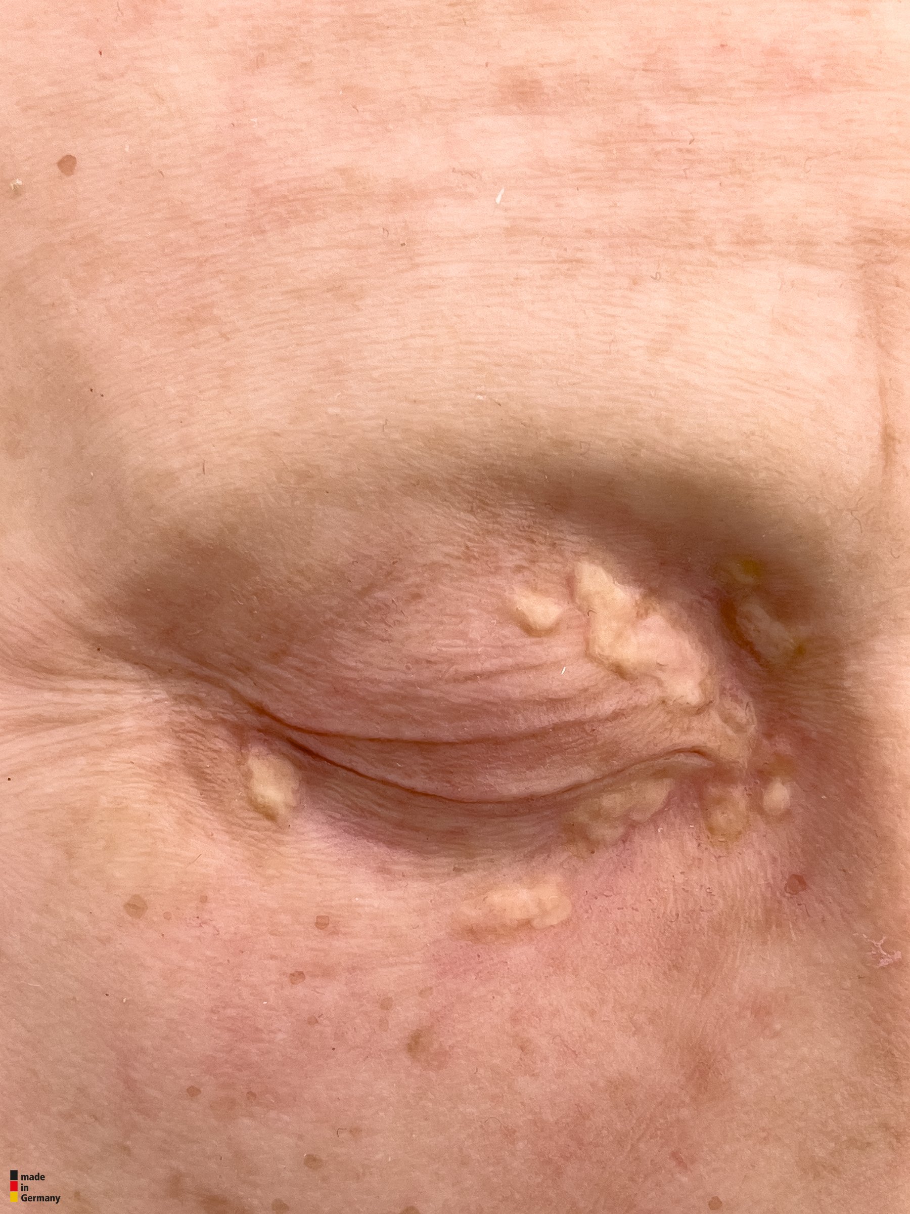 Pocketwound Xanthelasma (Lidknötchen) – Bild 2