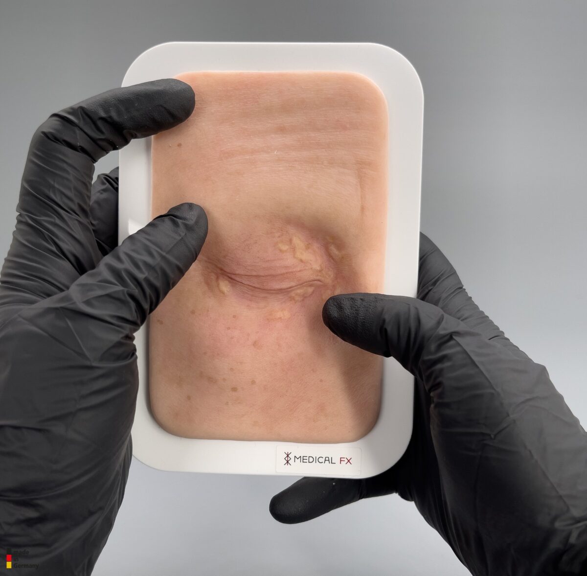 Pocketwound Xanthelasma (Lidknötchen)