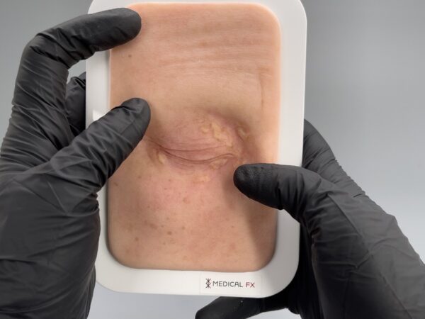 Pocketwound Xanthelasma (Lidknötchen) – Bild 3