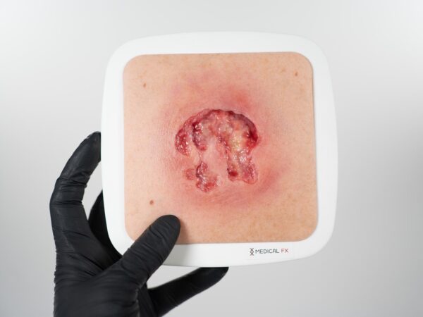 Rahmenmodell Ulcer mit Unterminierung – Bild 2