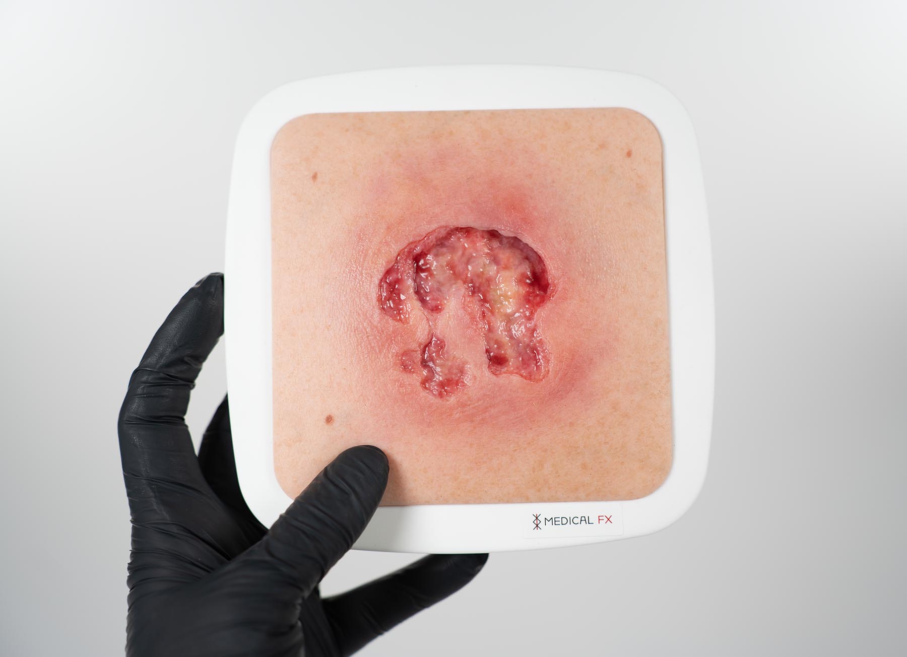 Rahmenmodell Ulcer mit Unterminierung – Bild 2