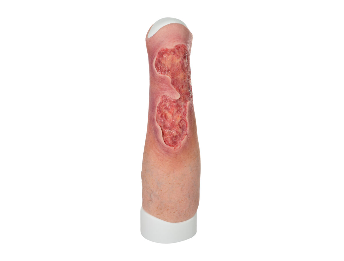 Sleeve Bein mit Gamaschenulkus